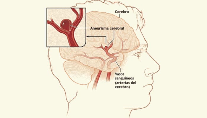 Imagen de aneurisma cerebral, mostrando una dilatación anormal de un vaso sanguíneo en el cerebro.