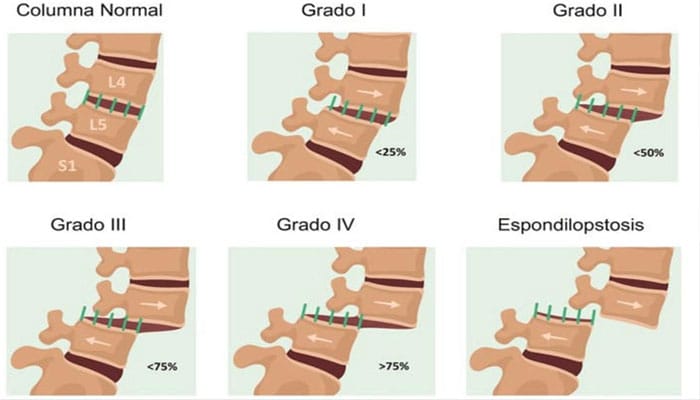 Ilustración médica de la espondilolistesis mostrando el desplazamiento de una vértebra en la columna vertebral.
