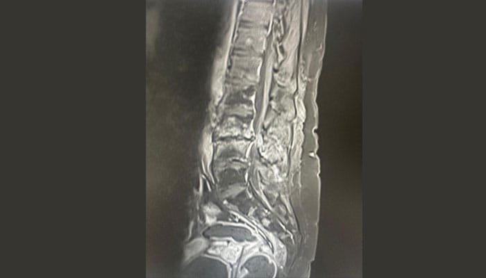 Imagen de una columna vertebral con estenosis de canal lumbar, mostrando la compresión de los nervios espinales.
