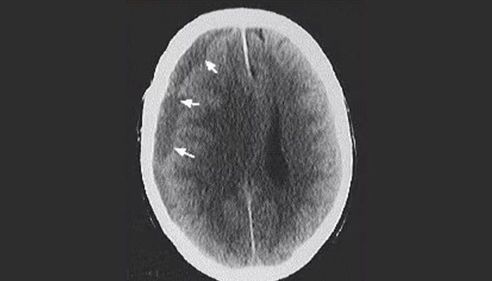 Imagen de hematoma subdural en el cerebro, mostrando la acumulación de sangre entre la duramadre y el cerebro.