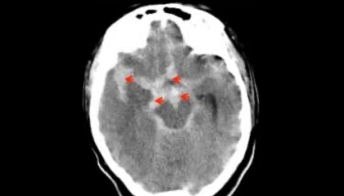 Imagen de hemorragia subaracnoidea, mostrando la acumulación de sangre en el espacio subaracnoideo del cerebro.