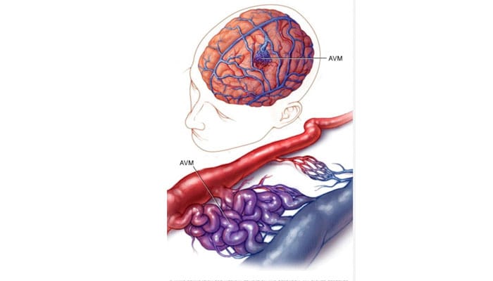 Imagen de malformaciones cerebrales, mostrando anomalías estructurales en el cerebro que afectan su desarrollo y función.