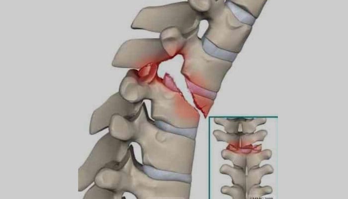 magen de trauma raquimedular, mostrando una lesión en la médula espinal y su impacto en el sistema nervioso.