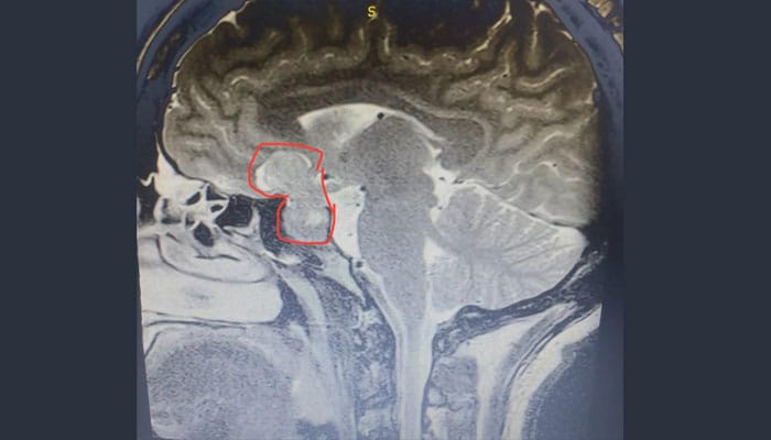 Imagen de tumor de hipófisis, mostrando el crecimiento anormal en la glándula pituitaria.