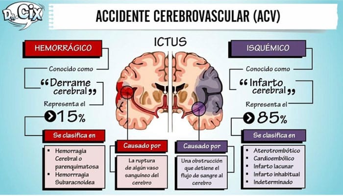 Imagen de accidente cerebrovascular (ACV), mostrando la obstrucción o ruptura de un vaso sanguíneo en el cerebro.