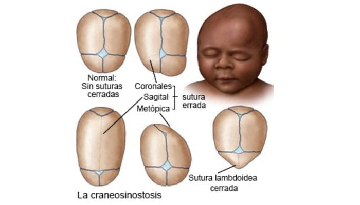 Imagen de un bebé diagnosticado con craneosinostosis, mostrando una deformidad en el cráneo debido al cierre prematuro de suturas.