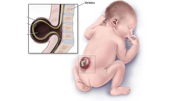 Imagen de espina bífida en un recién nacido, mostrando la malformación en la columna vertebral.