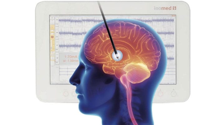 Imagen de neurocirugía funcional, mostrando la intervención en áreas específicas del cerebro para tratar trastornos neurológicos.