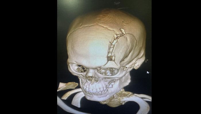 Imagen de trauma craneal en un adulto, mostrando el impacto en el cráneo y el cerebro.
