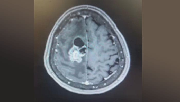 tumor cerebral