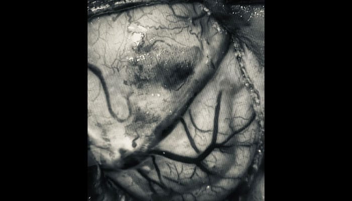 Imagen de tumor cerebral maligno, mostrando el crecimiento anormal de células en el cerebro.