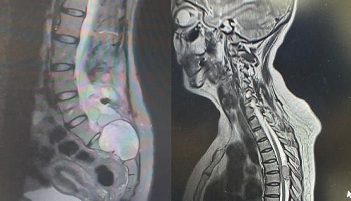 Imagen médica de un tumor en la columna vertebral que afecta las vértebras y el canal espinal.