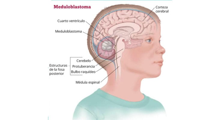Imagen de tumores cerebrales en niños, con ilustración de diferentes tipos y su ubicación en el cerebro.